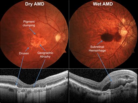 Macular Degeneration - Prompt Treatment | myeyespecialist