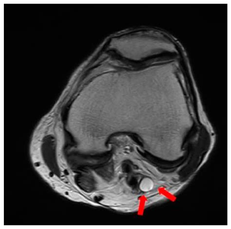 Palsy of Both the Tibial Nerve and Common Peroneal Nerve Caused by a ...