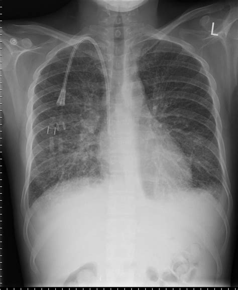 Post Gad: Pulmonary Edema & Kerley B lines
