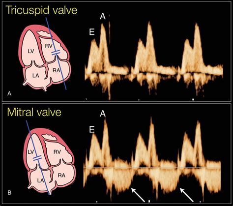 Pulsed doppler in fetal echocardiography – Artofit