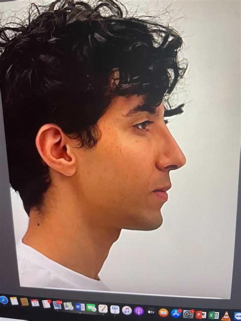 double jaw surgery ccw rotation for “long face syndrome” : u/nyanlong