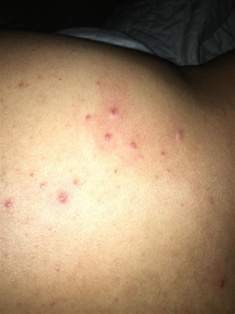 Help what are these red bumps on my back?? They don’t itch or hurt but they have been on my back ...