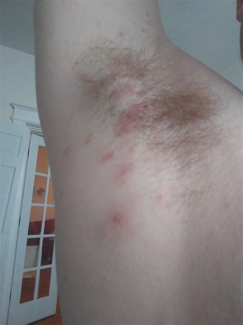 Armpit Rash Color – Fungal Underarm Rash – UIEB