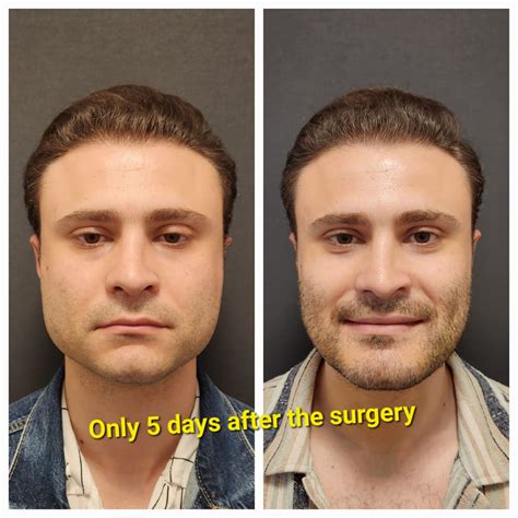 What You Need to Know About Double Jaw Surgery Before and After – Prof. Dr. Celal Çandırlı