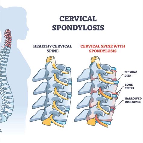 Cervical Spondylosis | Punarva