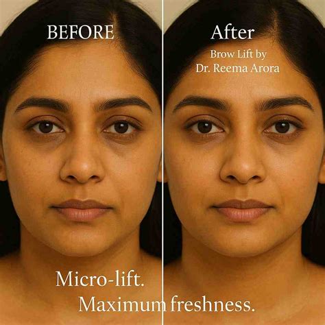 Eyebrow Lift in Delhi | Non-Surgical Brow Lift Cost, Results & Doctor-Led Care
