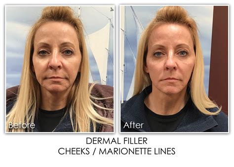 Do Cheek Fillers Lift Marionette Lines at Gary Delariva blog
