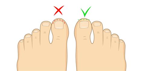 How to Cut Your Toenails Correctly — Blackwood Podiatry | Your local podiatrist in Blackwood