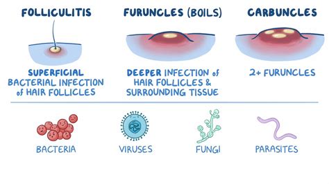 Abscess Vs Boil Pictures at Walter Abbott blog