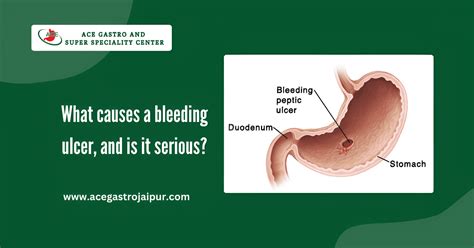 What are the symptoms of Diarrhea? | ACE Gastro