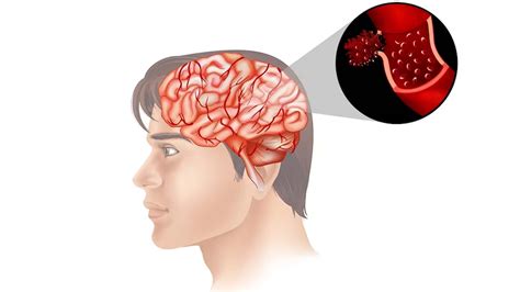 Can Stress Cause Brain Tumors? – NutritionFact.in