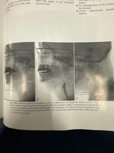 Image result for Modified Barium Swallow Study Basic