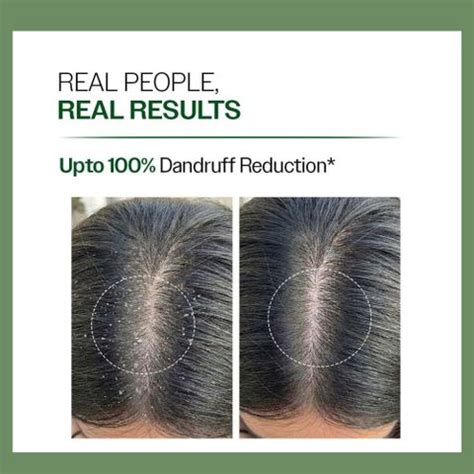 YeoJi Anti-Dandruff Shampoo | Triple Action & 100% Dandruff Reduction ...