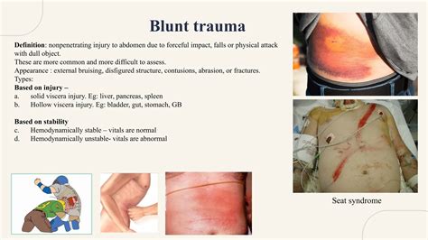 abdominal trauma basics, diagnosis, treatment, organ wise classifications | PPTX