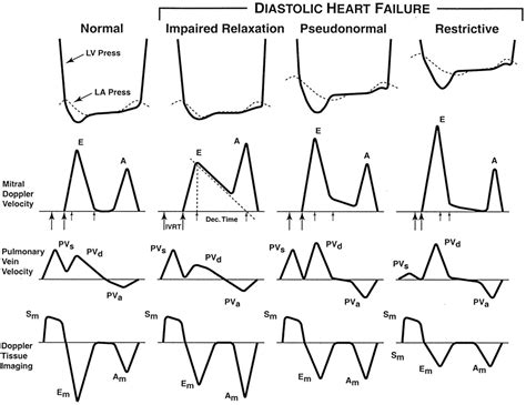 Image result for Moderate Diastolic Dysfunction