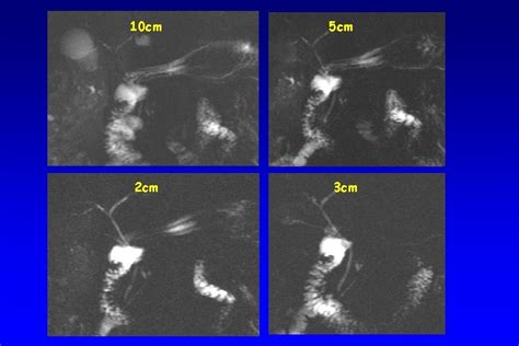 Image result for Abnormal MRCP