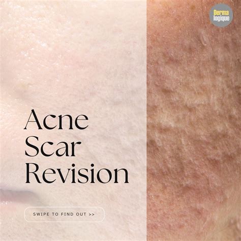The ultimate guide on acne scar revision – Dermalogique