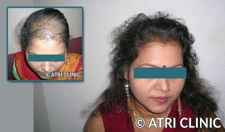 Hair Transplant in Kolkata | Best Hair Clinic - ATRI Clinic