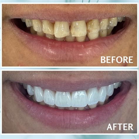 Treat Swollen Gums After Flossing | Riverview Dental Tips