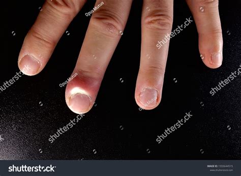 Bacterial Infection Finger Inflammation White Pus Stock Photo ...