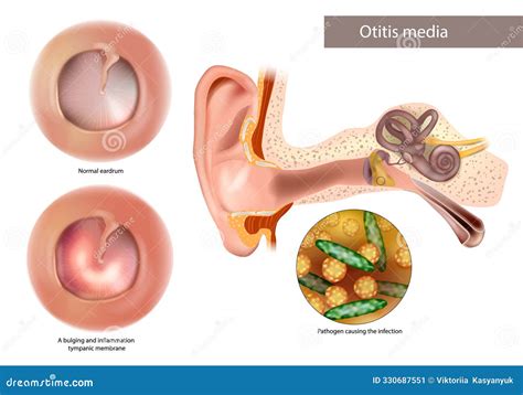 Otitis Media, A Group Of Inflammatory Diseases Of The Middle Ear, 3D Illustration Royalty-Free ...