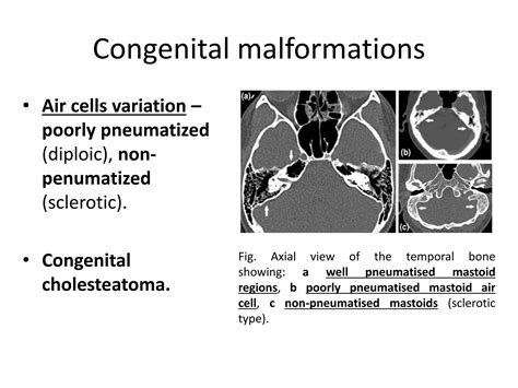 Mastoid diseases imaging | PPTX