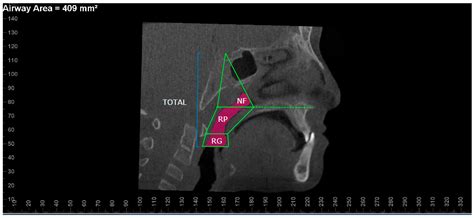 Three-Dimensional Evaluation of the Effects of Different Treatment ...