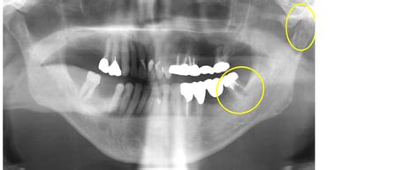 Septic Arthritis of the Temporomandibular Joint without an Apparent ...