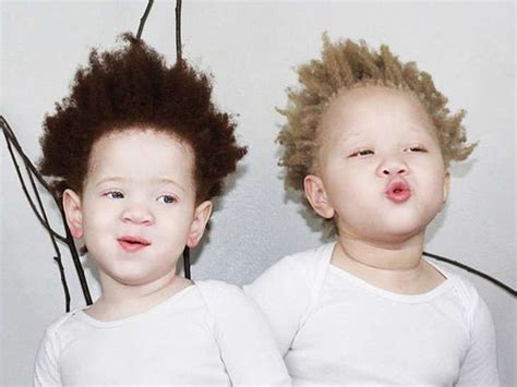Parents of albino black twins are sick of people hurtful question ...