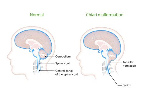 Chiari Malformations | Concise Medical Knowledge