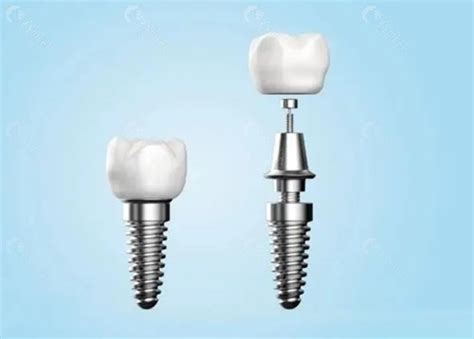 Implant Surgical Guide-Shenzhen Palmary Medical technology co.,Ltd.