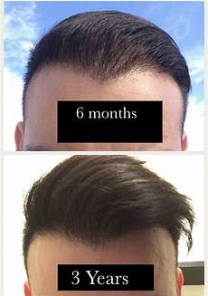 Baby Hair Loss After 6 Months by 6 Months Post Op Not Happy With The Density Of My Hair Baby Hair Loss After 6 Months