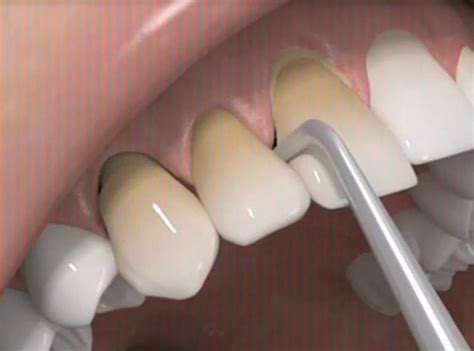 Waldent Automatic Crown Remover Black Set of 12 (K21/4) – Waldent.com