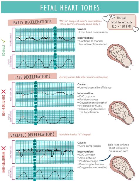 Fetal Heart Tones - Normal Ranges, Decelerations, Causes & Interventions