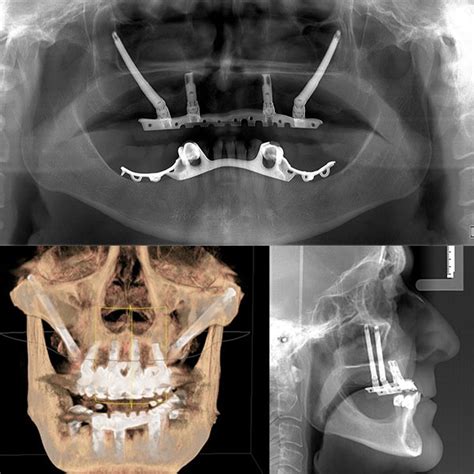 Odontología Borja | IMPLANTES DENTALES