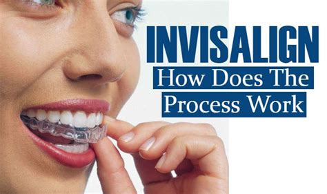 Image result for Invisalign Process