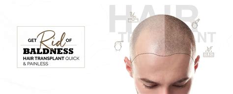 India's no 1 Hair Transplant Clinic located in Gurgaon | AKS Clinic
