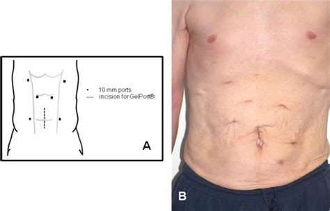 Image result for Hal Nephrectomy