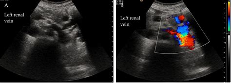 Ultrasonic Imaging in Liver Disease: From Bench to Bedside | IntechOpen