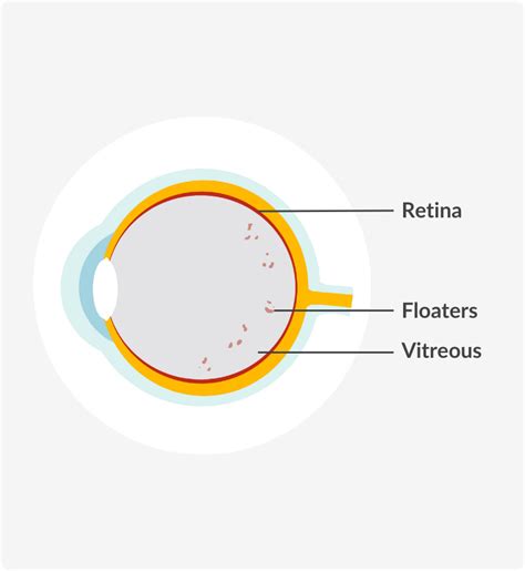 Image result for Eye Floaters Under Microscope