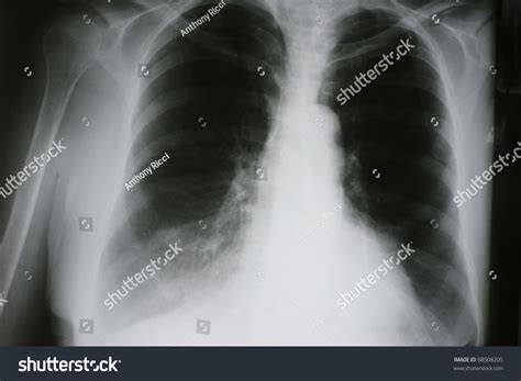 Xray Of Chronic Obstructive Pulmonary Disease, Copd, With Right Middle ...
