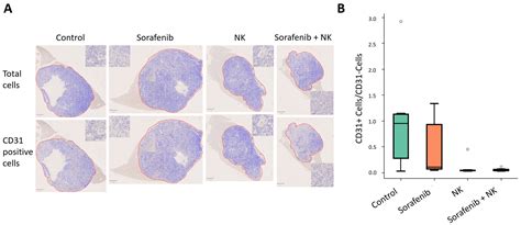 Therapy Combining Sorafenib and Natural Killer Cells for Hepatocellular ...