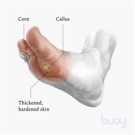 What Causes Calluses On Foot Best Sale | emergencydentistry.com
