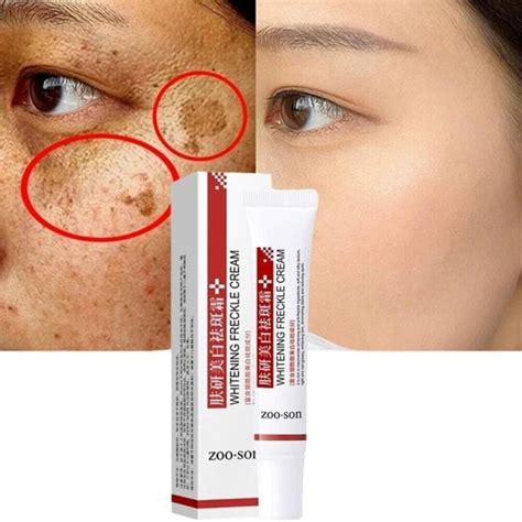 Buy Melasma and Freckle Cream Freckle Cream Remove Dark Spots Anti ...