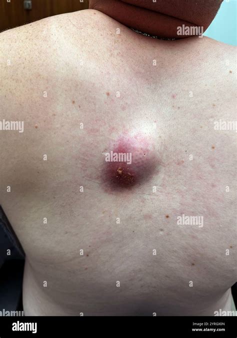 Image result for Giant Abscess Exploding On Back