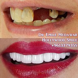 Transform Your Smile with Porcelain E‑max Veneers in Lebanon