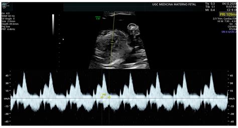 Transplacental Treatment of Fetal Tachyarrhythmia | Encyclopedia MDPI