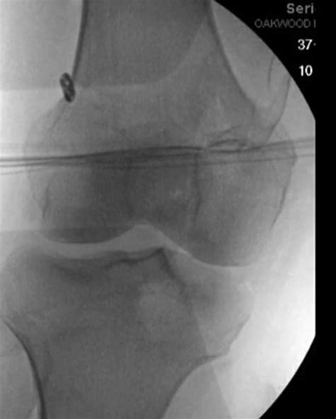 Combined Medial Patellofemoral Ligament, Medial Quadriceps Tendon ...