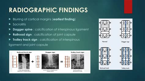 ANKYLOSING SPONDYLITIS.pptx medical terminology | PPT