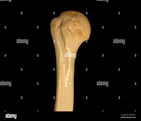 CT scan of head of humerus 3D of Computed Tomography Volume Rendering ...